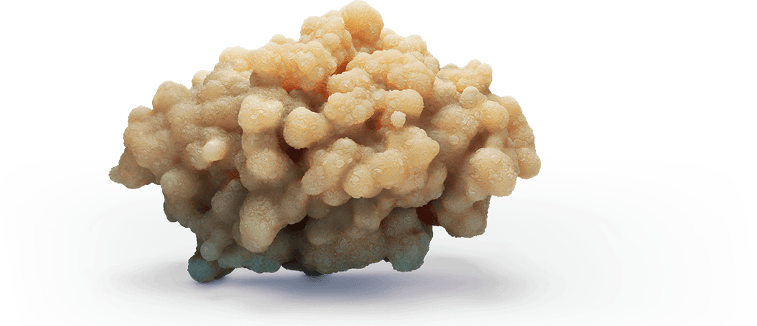 Calcium Oxalate Stone - Kidney Stone